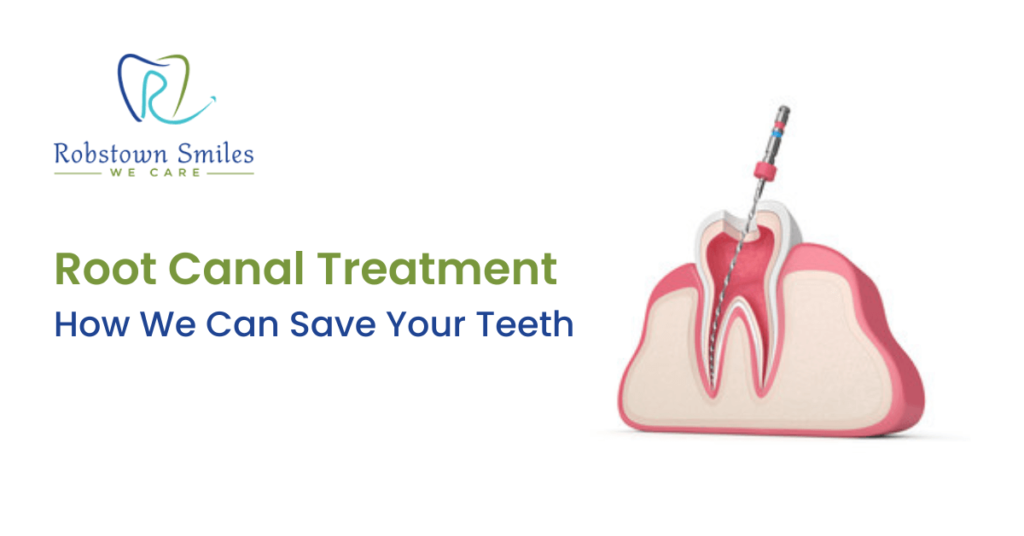 Root Canal Treatment : How We Can Save Your Teeth - Robstown Smiles