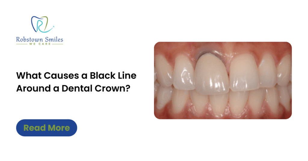 what-causes-a-black-line-around-a-dental-crown-robstown-smiles